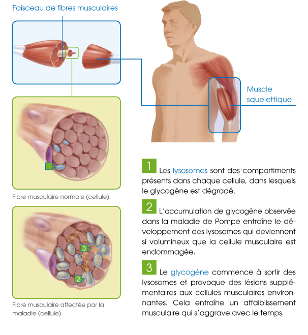 Maladie de Pompe