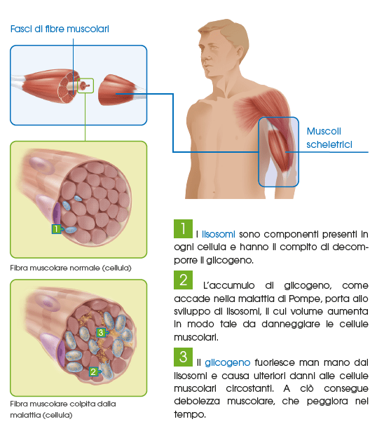 Malattia di Pompe